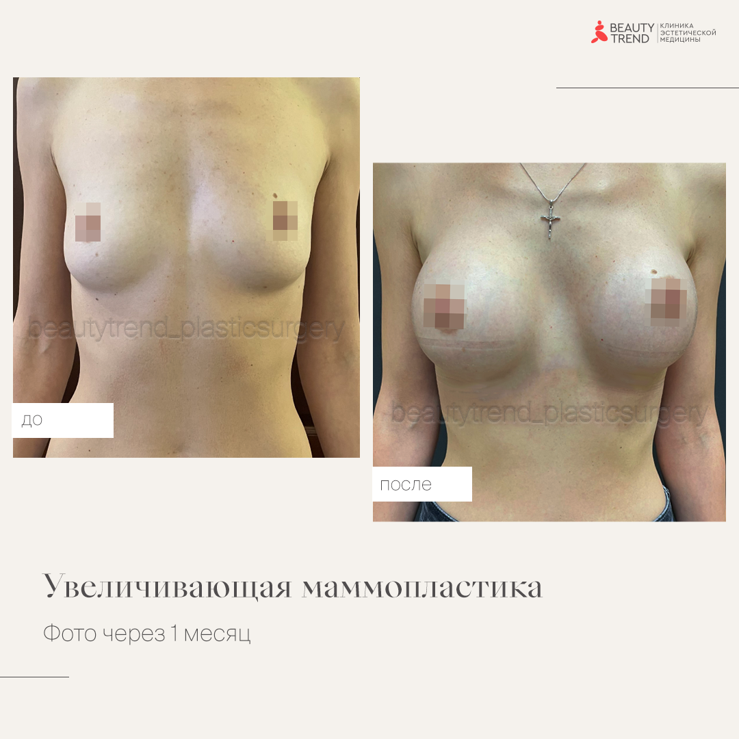 Увеличение груди имплантами, 3А - 2
